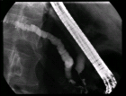 images/thumbs/Fall3ERCP.png